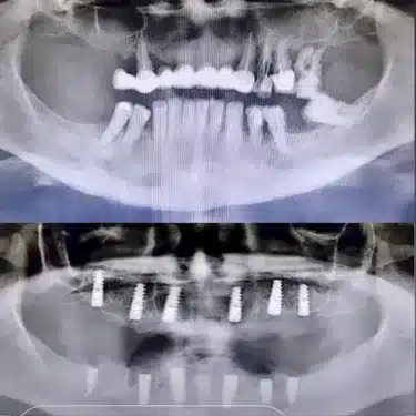 Dental Implants Using the All-on-4 and All-on-6 Systems