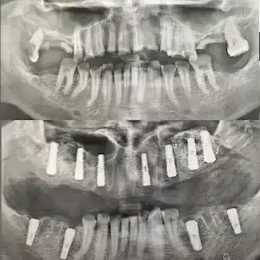 Dental Implants Using the All-on-4 and All-on-6 Systems