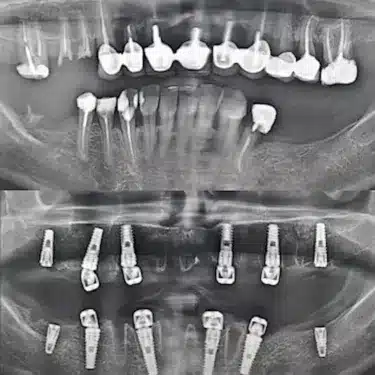 Dental Implants Using the All-on-4 and All-on-6 Systems