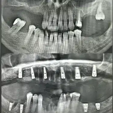 Dental Implants Using the All-on-4 and All-on-6 Systems