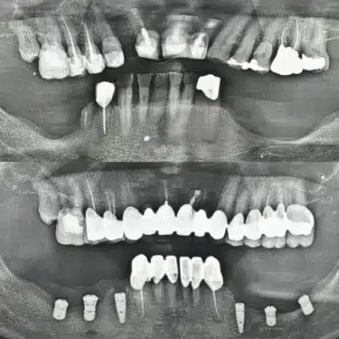 Dental Implants Using the All-on-4 and All-on-6 Systems