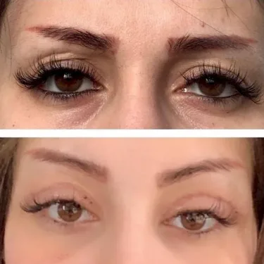 Блефаропластика