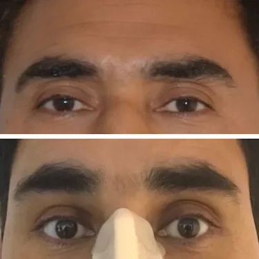 Блефаропластика