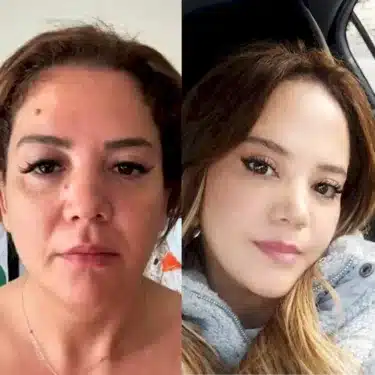 Подтяжка лица и шеи