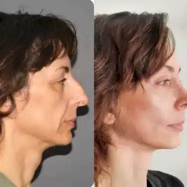 Подтяжка лица и шеи