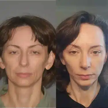 Подтяжка лица и шеи