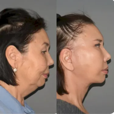 Подтяжка лица и шеи