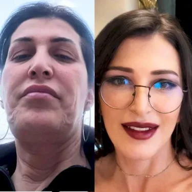 Подтяжка лица и шеи