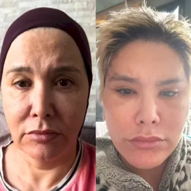 Подтяжка лица и шеи