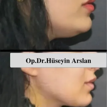 Подтяжка шеи