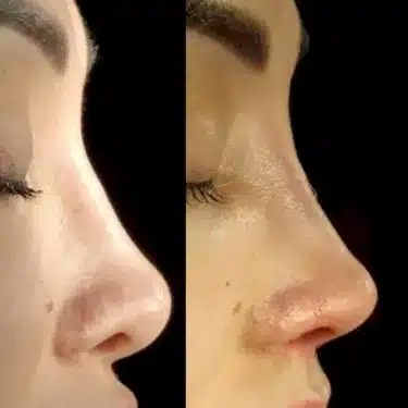 Ринопластика