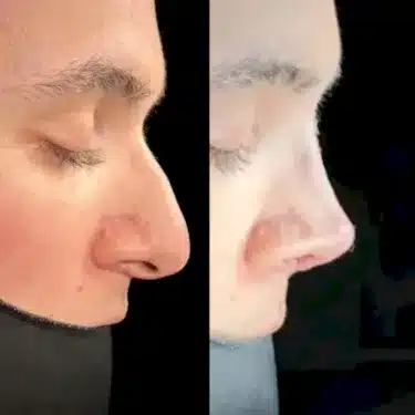 Ринопластика