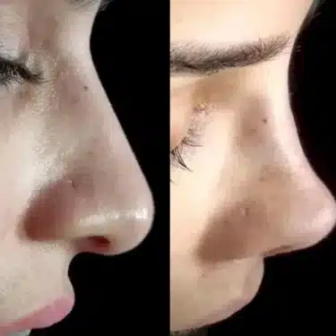 Ринопластика