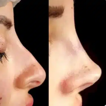 Ринопластика