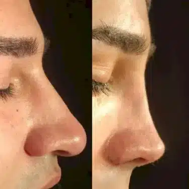 Ринопластика