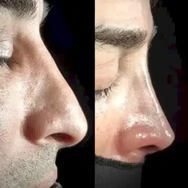 Ринопластика