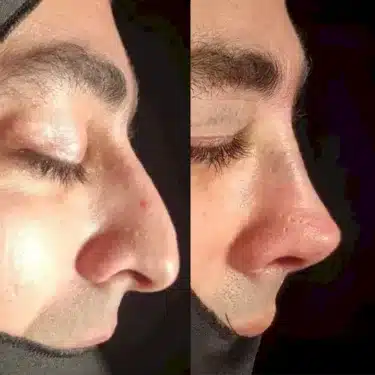 Ринопластика