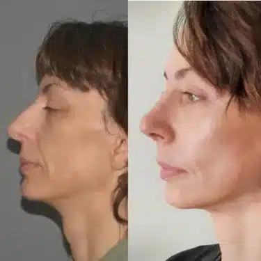 Ринопластика