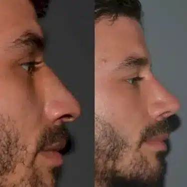 Ринопластика