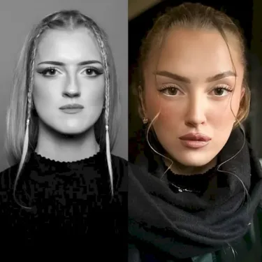 Подтяжка лица и шеи