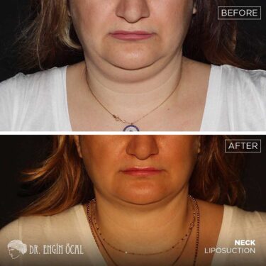 Neck Liposuction