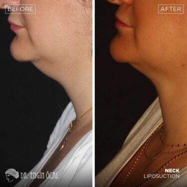Neck Liposuction