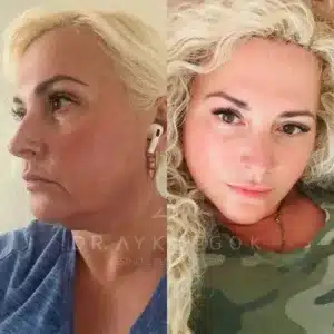 Facelift in Turkey by Aykut Gok