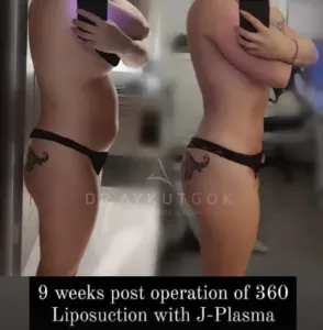 Liposuction in Turkey by Aykut Gok