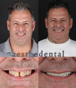 dental implants in Turkey