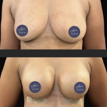 Breast Augmentation