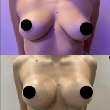 Breast Augmentation