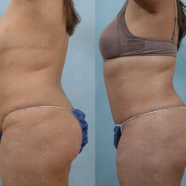 Liposuction