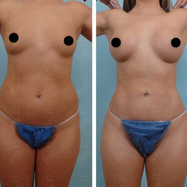 Liposuction