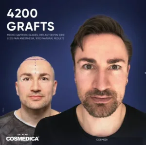 FUE hair transplant in Istanbul with Levent Akar