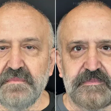 Blepharoplasty (eyelid surgery)