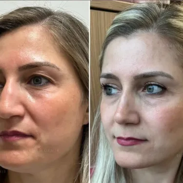 Blepharoplasty (eyelid surgery)