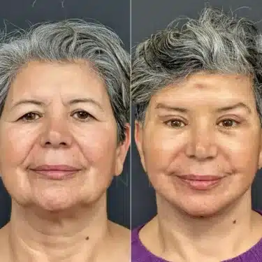 Blepharoplasty (eyelid surgery)