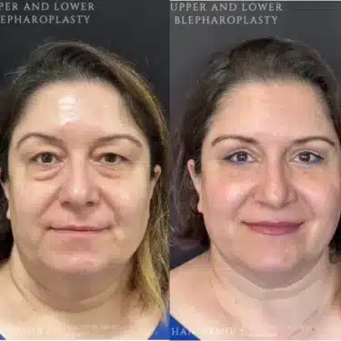 Blepharoplasty (eyelid surgery)