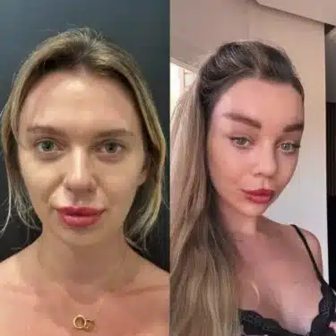 Facelift