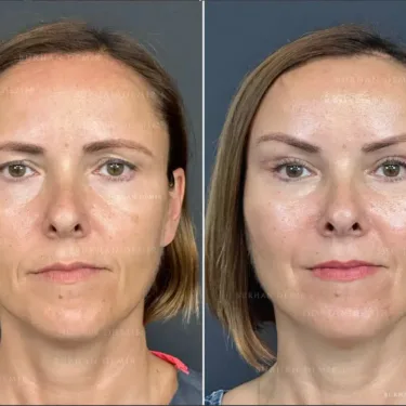 Facelift