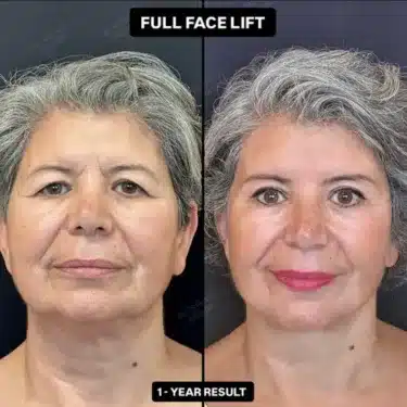 Facelift