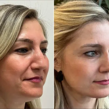 Facelift