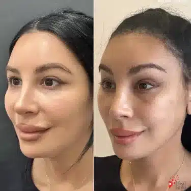 Facelift
