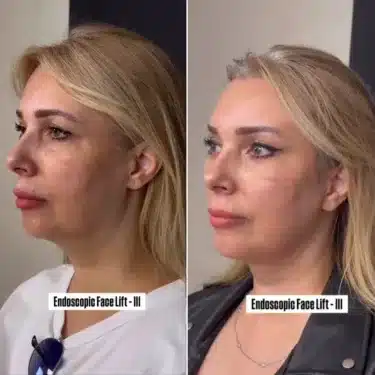 Facelift