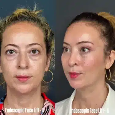 Facelift