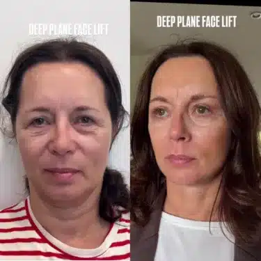 Facelift