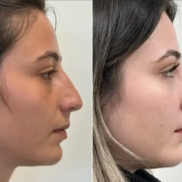 Rhinoplasty