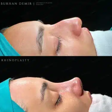 Rhinoplasty
