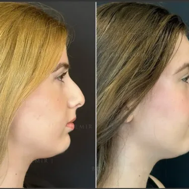 Rhinoplasty