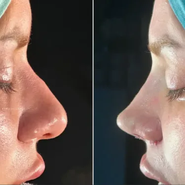 Rhinoplasty